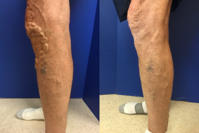 Sclerotherapy before and after photo