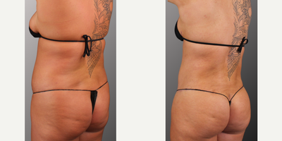 BodyTite before and after photo