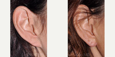 Ear Surgery before and after photo