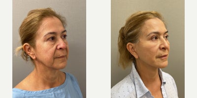 Facelift before and after photo