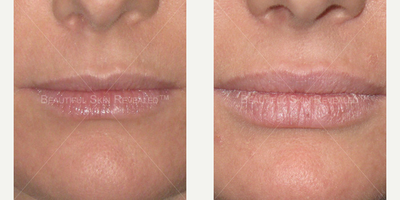 Lip Fillers before and after photo