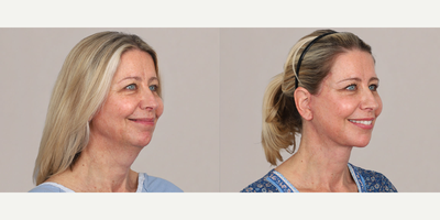 Neck Lift before and after photo