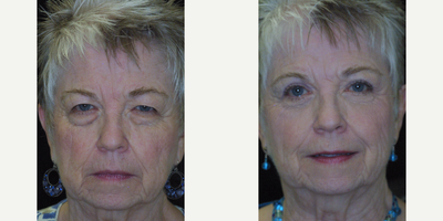 Ptosis Surgery before and after photo