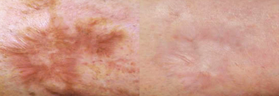 Scar Removal before and after photo