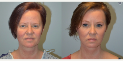 CO2 Laser before and after photo