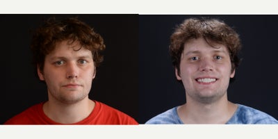 Dental Crown before and after photo