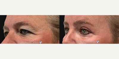 Eyelid Surgery before and after photo