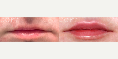 Lip Fillers before and after photo