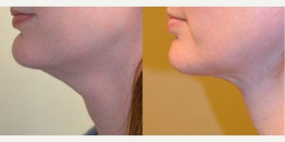 Neck Lift before and after photo