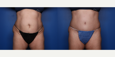Tummy Tuck before and after photo