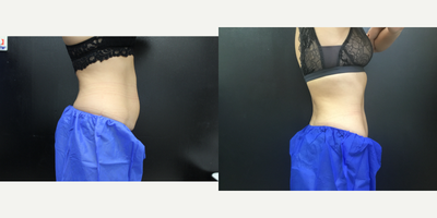 CoolSculpting before and after photo