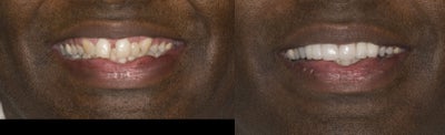Dental Crown before and after photo