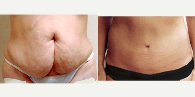 Tummy Tuck before and after photo