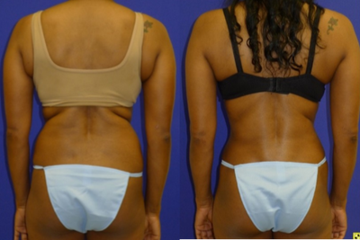 Vaser Liposuction before and after photo