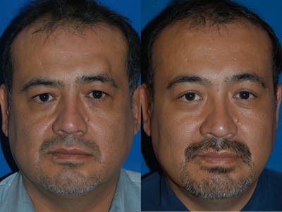 Brow Lift before and after photo