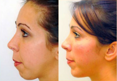 Chin Implant before and after photo