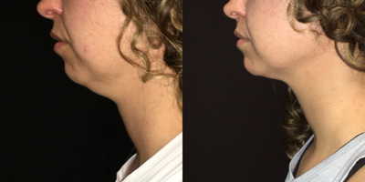 CoolSculpting before and after photo