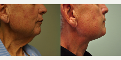 Neck Lift before and after photo