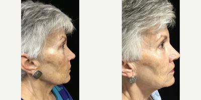 Opus Plasma before and after photo