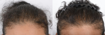 PRP for Hair Loss before and after photo
