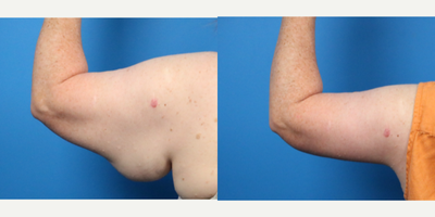 Arm Lift before and after photo