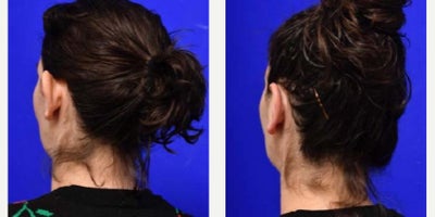 Ear Surgery before and after photo