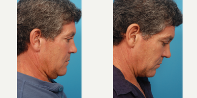 Liposuction before and after photo