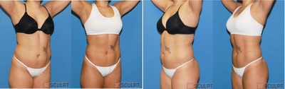 SculpSure before and after photo
