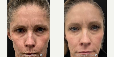 Botox before and after photo
