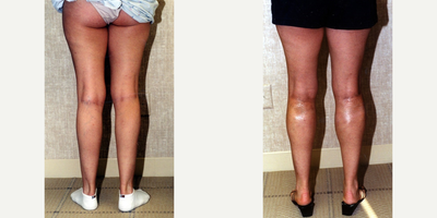 Calf Implant before and after photo