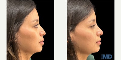 Dermal Fillers before and after photo