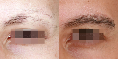 Eyebrow Transplant before and after photo