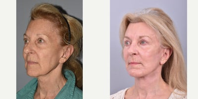 Facelift before and after photo