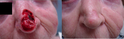 Mohs Surgery before and after photo