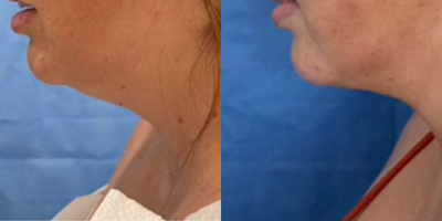 Vaser Liposuction before and after photo