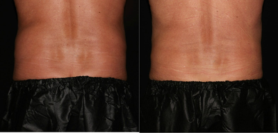 CoolSculpting before and after photo