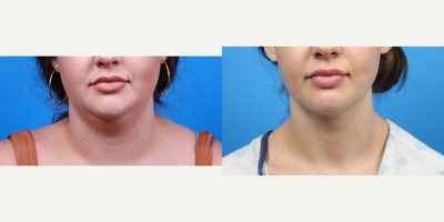 Liposuction before and after photo