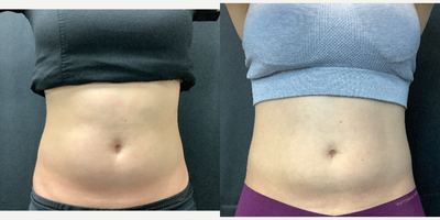 Semaglutide before and after photo