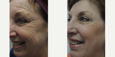 Voluma before and after photo
