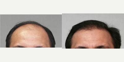 FUE Hair Transplant before and after photo