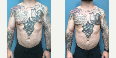 Gynecomastia Surgery before and after photo
