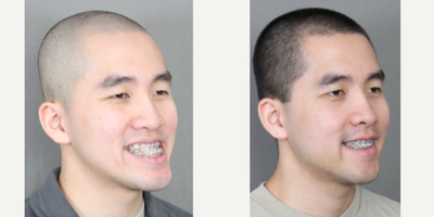 Jaw Surgery before and after photo