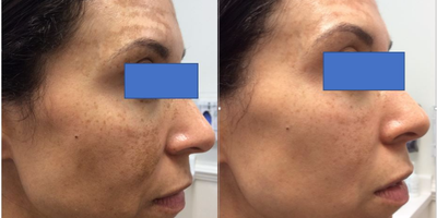 Laser Resurfacing before and after photo
