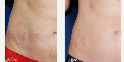 Laser Resurfacing before and after photo