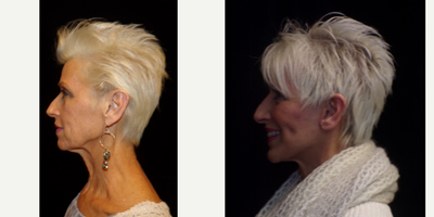 Mini Facelift before and after photo