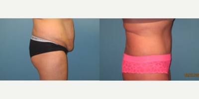 Tummy Tuck before and after photo