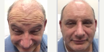 Botox before and after photo