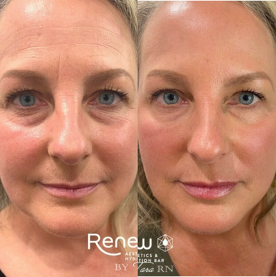 Dermal Fillers before and after photo