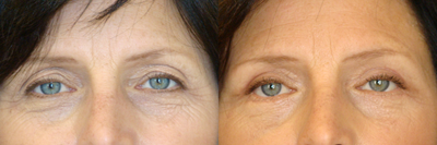 Eyelid Surgery before and after photo
