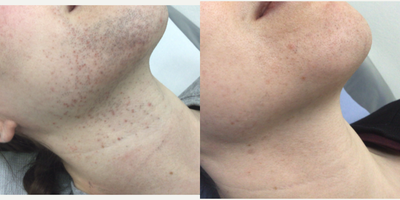 Laser Hair Removal before and after photo